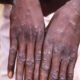 Suspected case of monkeypox reported in Karnataka