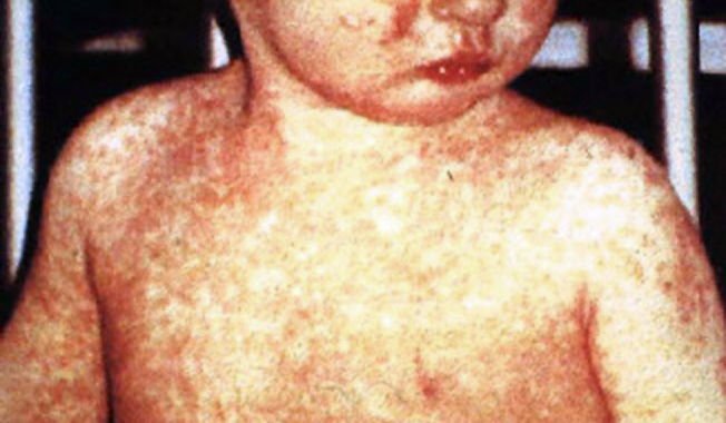 Ohio measles outbreak hits partly vaccinated children, babies too young for pictures